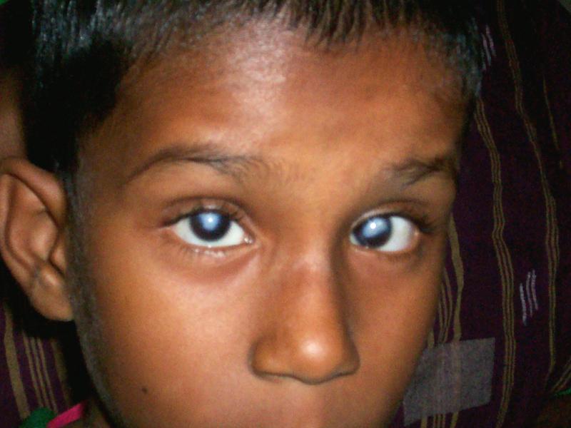 Left without treatment this youngster would have eventually gone blind. With the care of Rotary he now has perfect vision